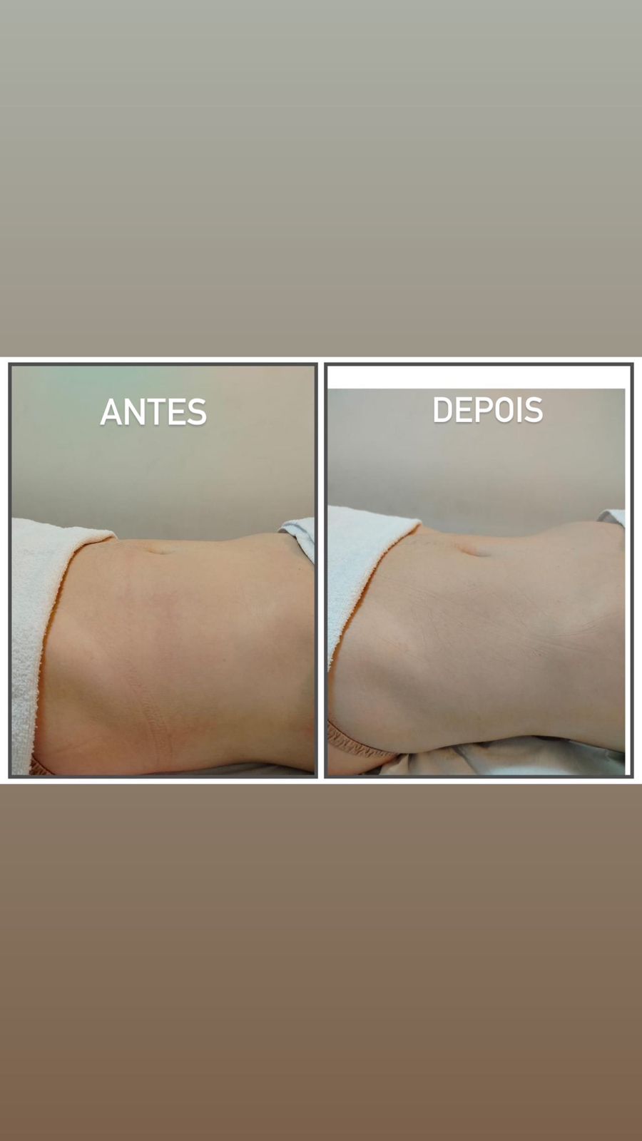 Antes e Depois Simone